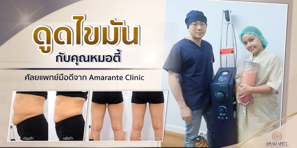 รีวิว ดูดไขมัน กับคุณหมอตี้