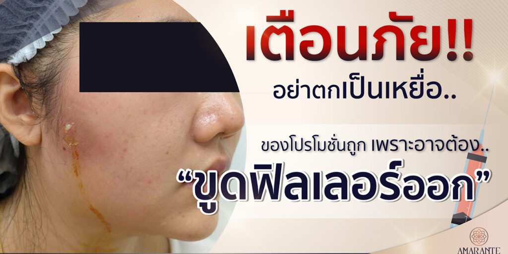 ขูดฟิลเลอร์ สลายฟิลเลอร์
