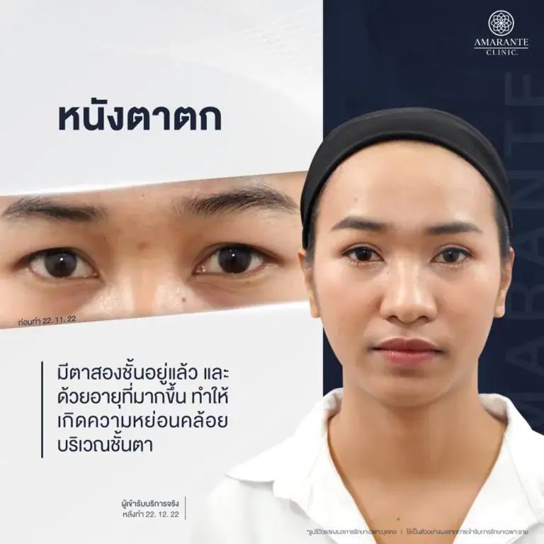หนังตาตก