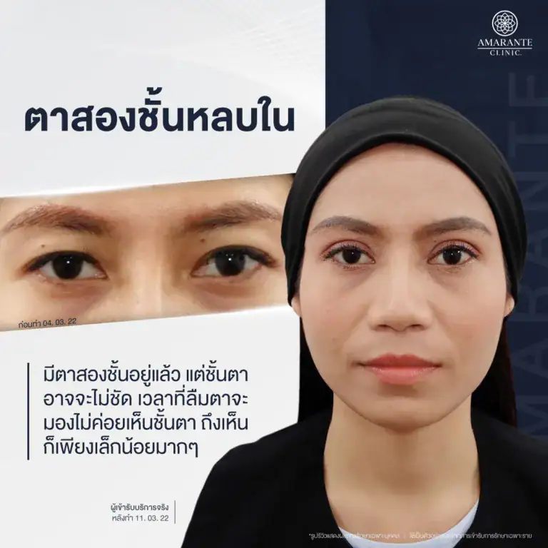 ชั้นตาไม่เท่ากัน