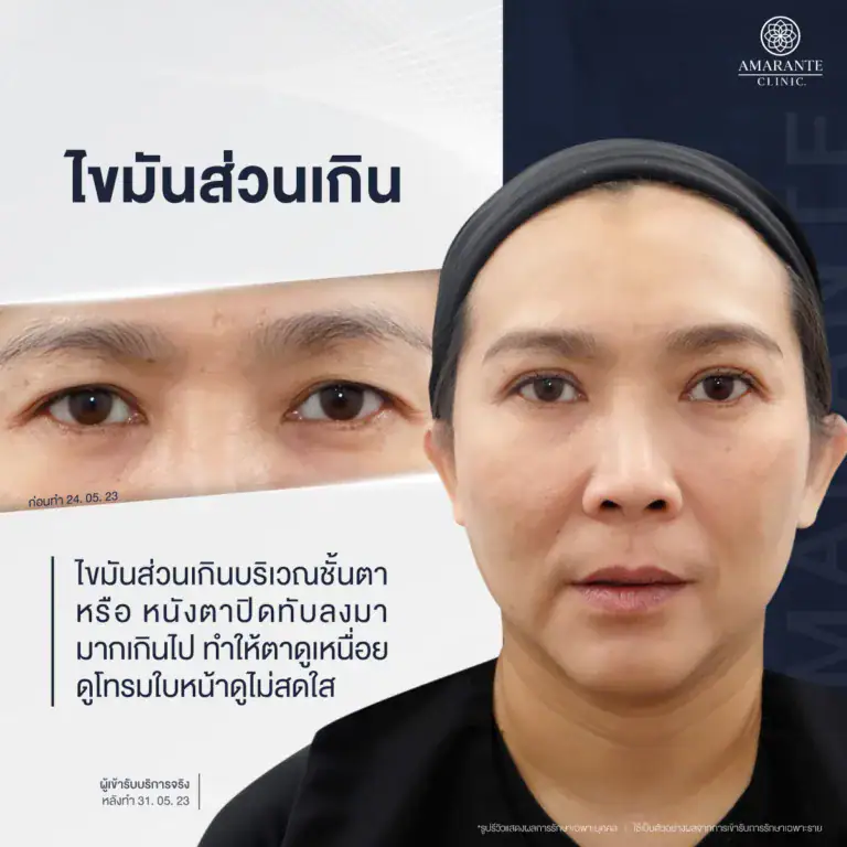ไขมันส่วนเกินบริเวณดวงตา