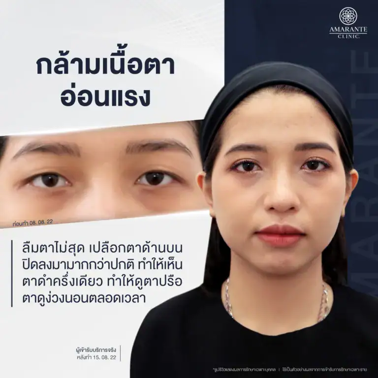 กล้ามเนื้อตาอ่อนแรง