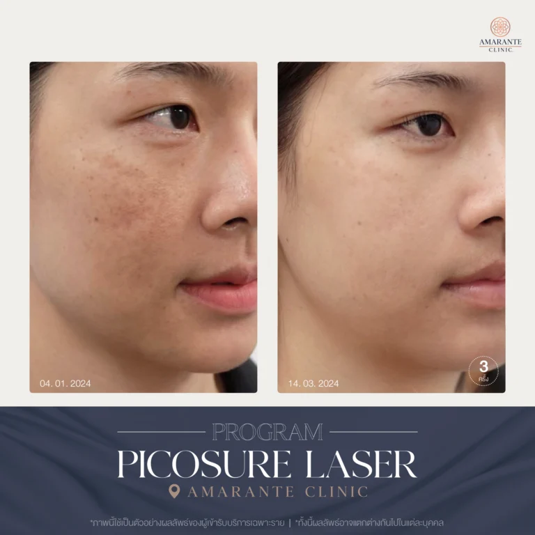 รีวิว ปัญหาฝ้ากระ ด้วย Picosure Laser 01-03_2024_02