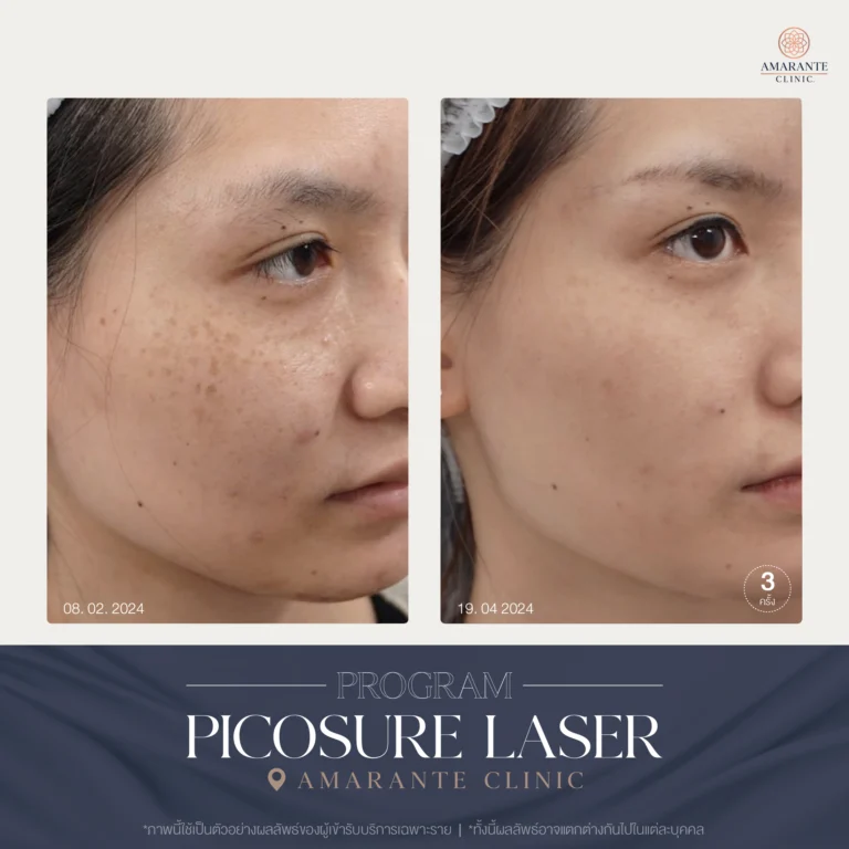 รีวิว ปัญหาฝ้ากระ ด้วย Picosure Laser 02-04_2024
