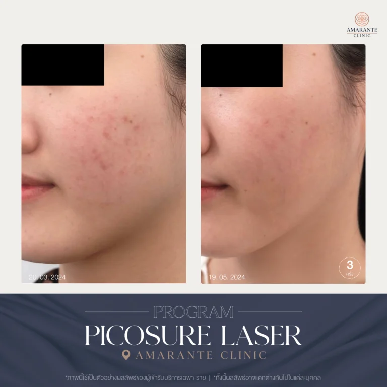 รีวิว ปัญหาฝ้ากระ ด้วย Picosure Laser 03-05_2024_01