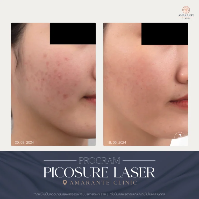 รีวิว ปัญหาฝ้ากระ ด้วย Picosure Laser 03-05_2024_02
