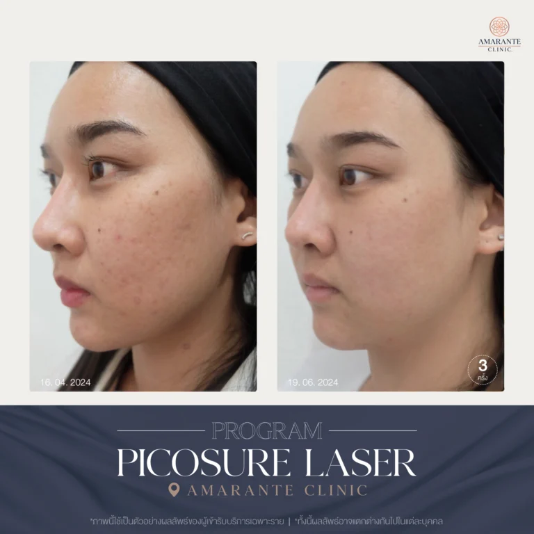 รีวิว ปัญหาฝ้ากระ ด้วย Picosure Laser 04-06_2024