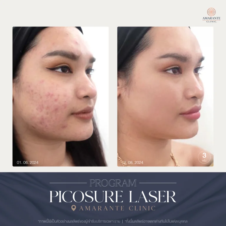 รีวิว ปัญหาฝ้ากระ ด้วย Picosure Laser 06-08_2024