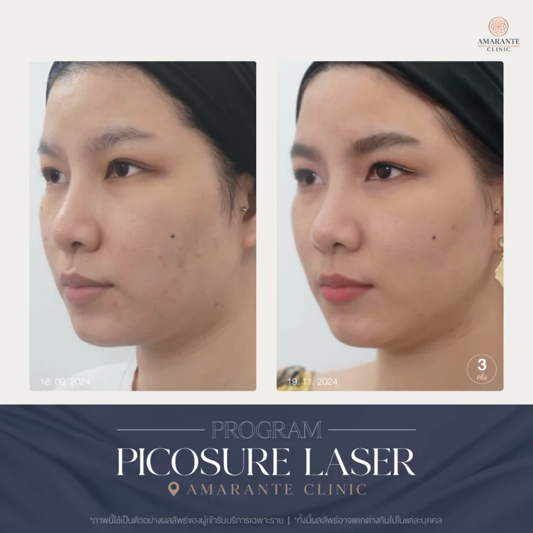 รีวิว ปัญหาฝ้ากระ ด้วย Picosure Laser 09-11_2024