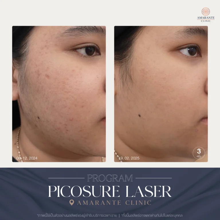 รีวิว ปัญหาฝ้ากระ ด้วย Picosure Laser 12-02_2024_2025_01