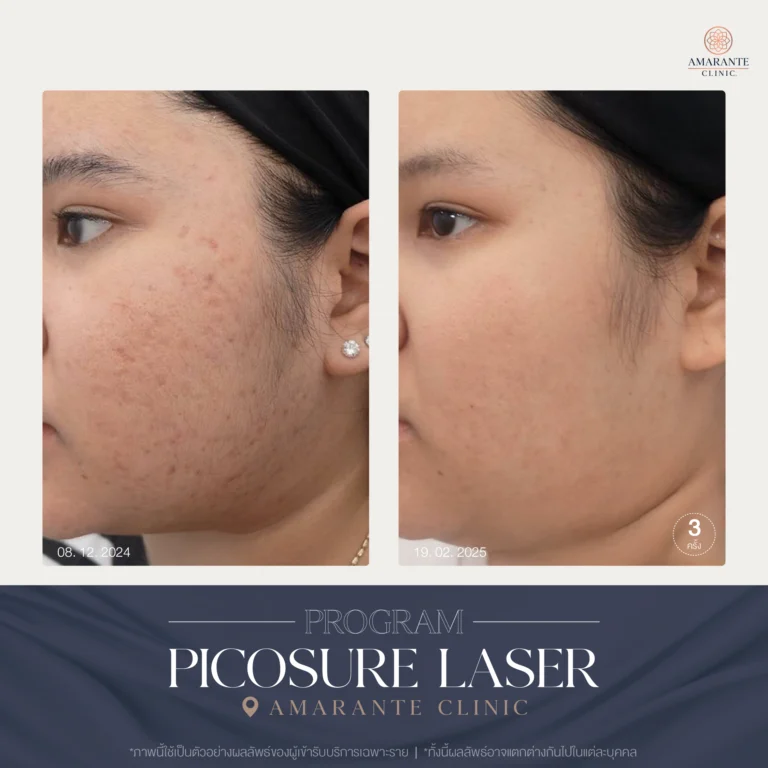 รีวิว ปัญหาฝ้ากระ ด้วย Picosure Laser 12-02_2024_2025_02