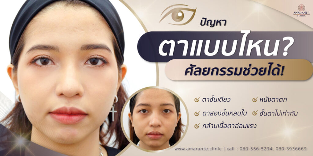 ตาแบบไหนศัลยกรรม ทำตาสองชั้น ช่วยได้