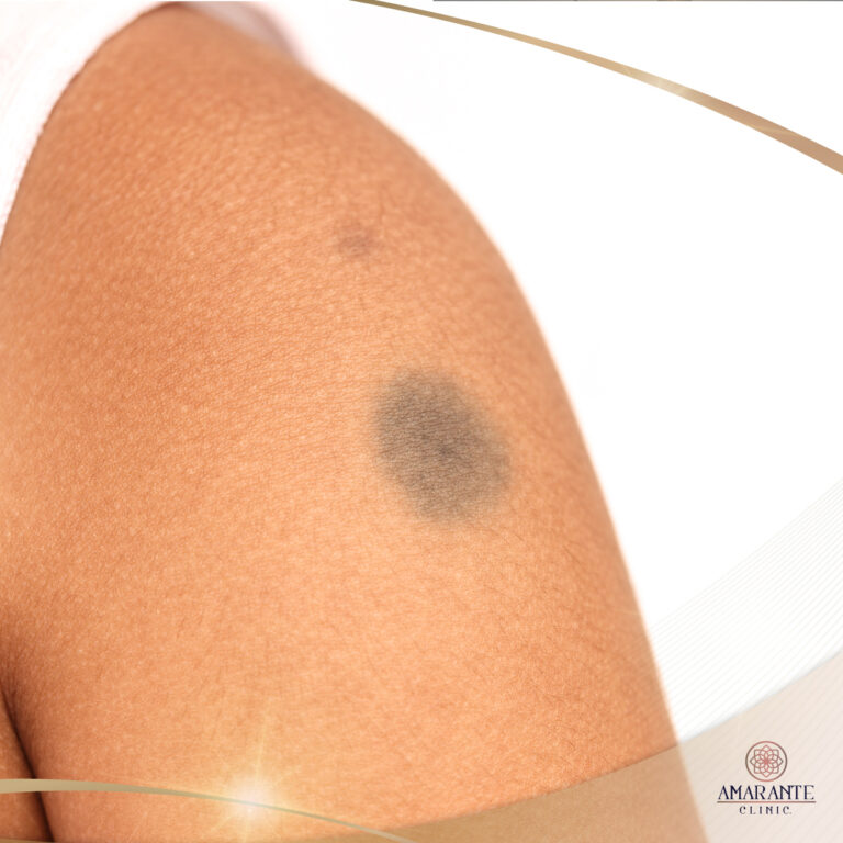 Picosure เลเซอร์ปานมองโกเลียน