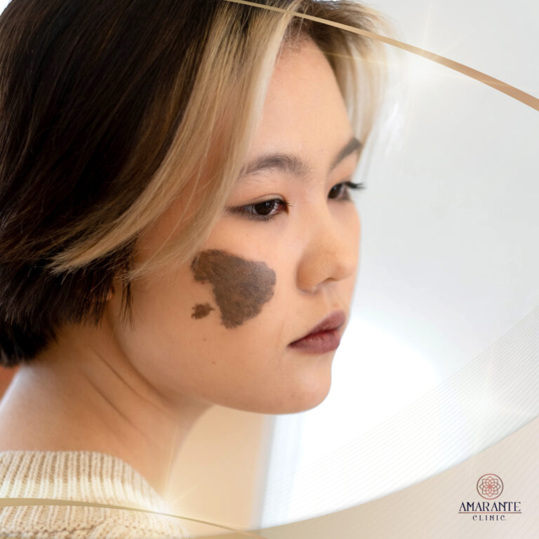 Picosure เลเซอร์ปานโอตะ