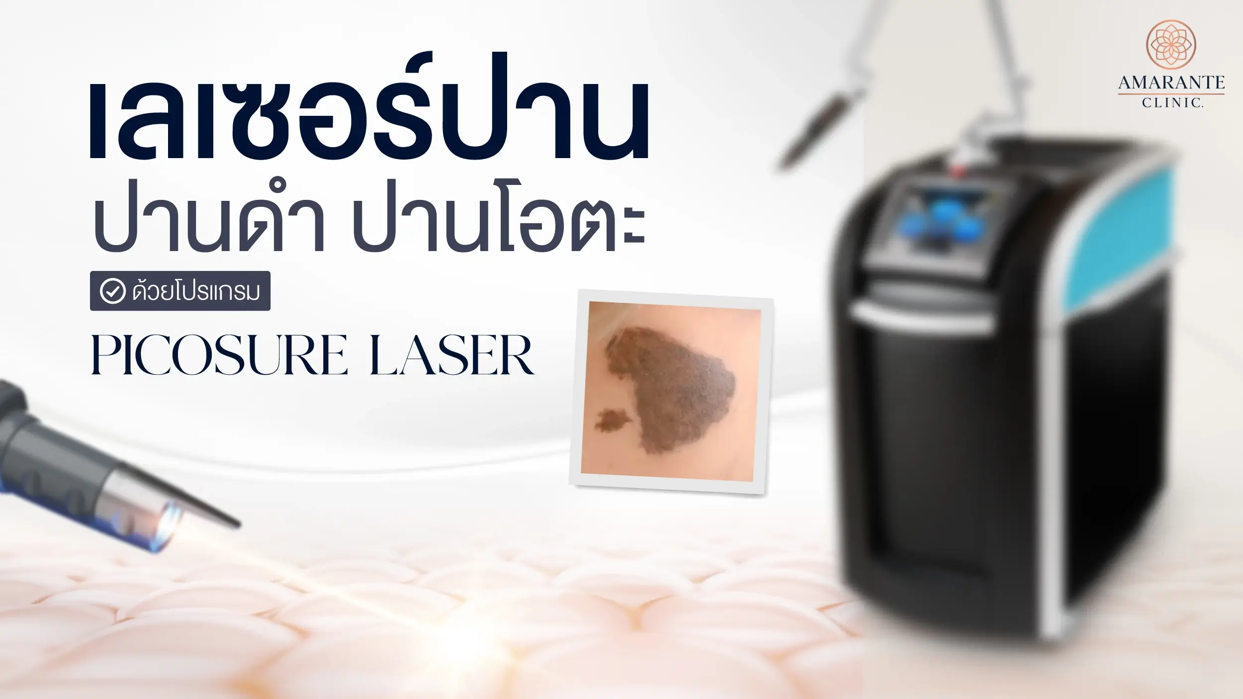 เลเซอร์ปาน ปานดำ ปานโอตะ รักษาด้วย Picosure Laser