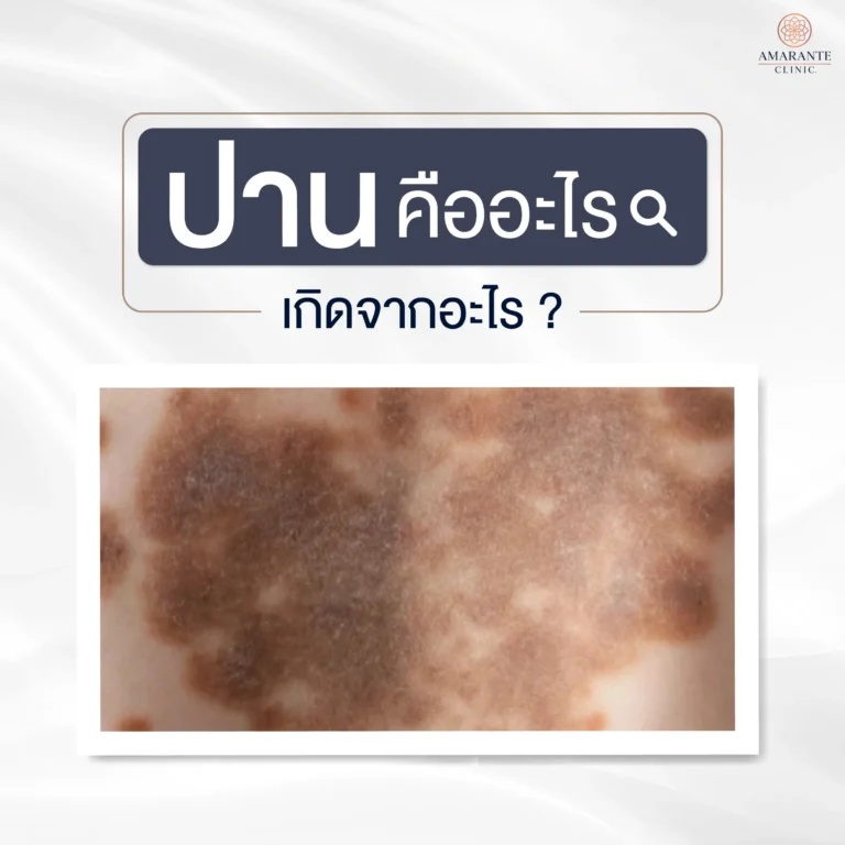 ปาน คืออะไร