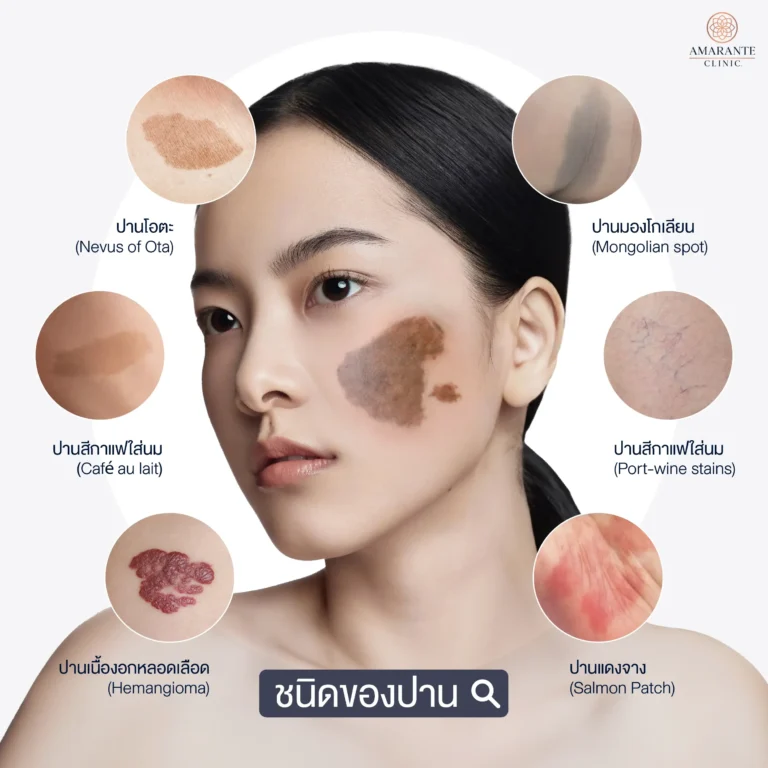 ชนิดของปาน