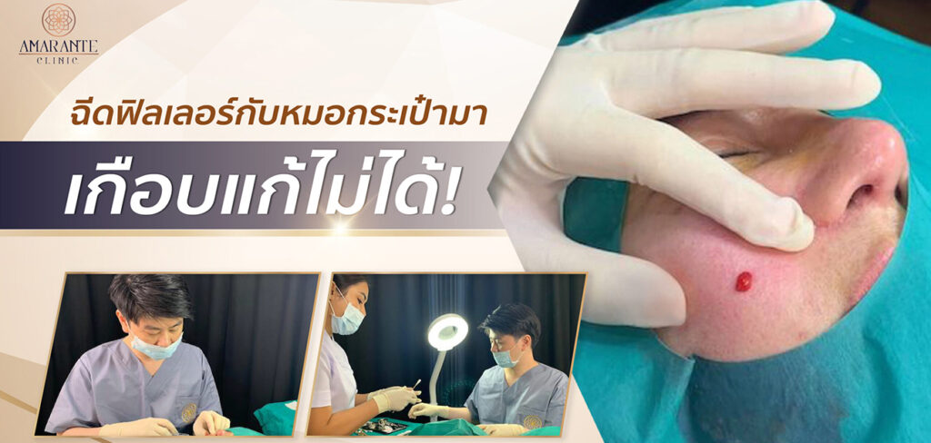 อุทาหรณ์ ฉีดฟิลเลอร์หมอกระเป๋า สุดท้าย หน้าพัง เกือบถึงขั้นศัลยกรรม