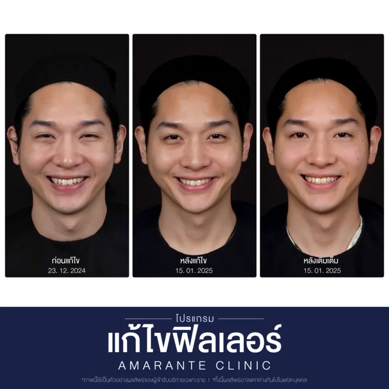 BA-แก้ไข-ฟิลเลอร์-02-scaled