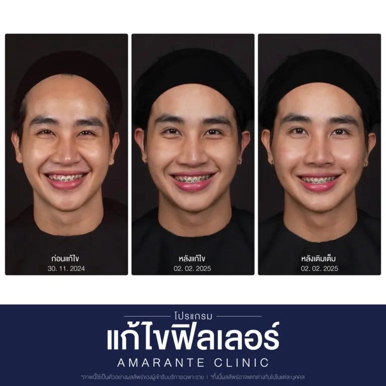 BA-แก้ไข-ฟิลเลอร์-04-scaled