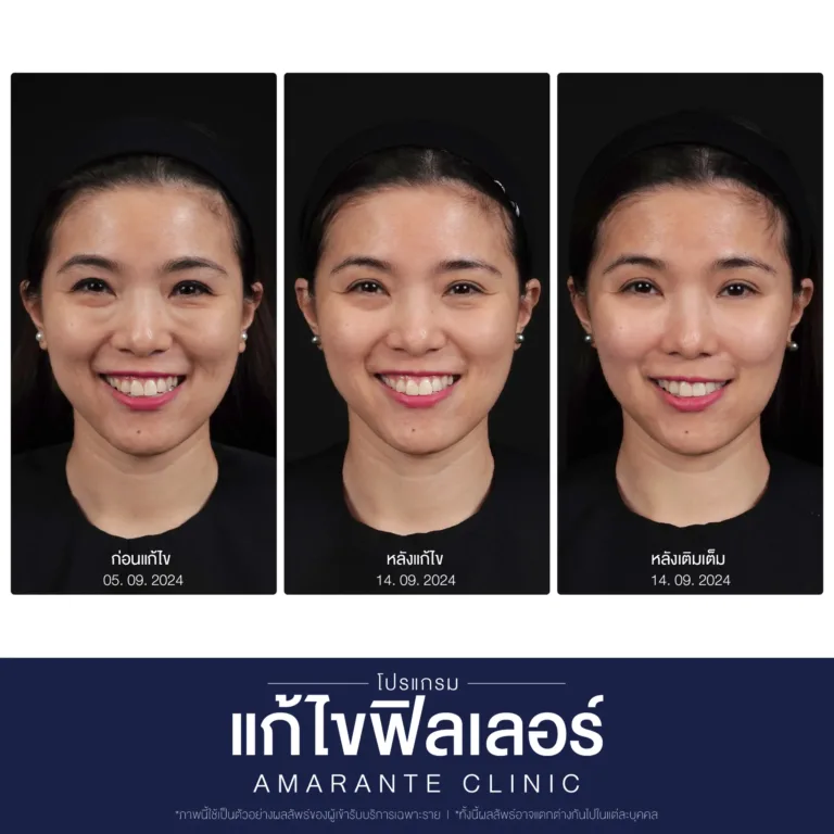 BA-แก้ไข-ฟิลเลอร์-05-scaled