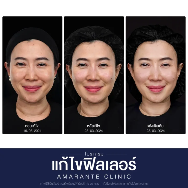 BA-แก้ไข-ฟิลเลอร์-10-scaled