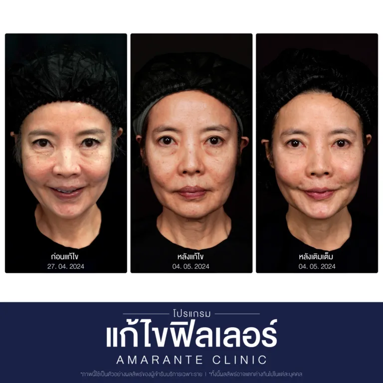 BA-แก้ไข-ฟิลเลอร์-11-scaled