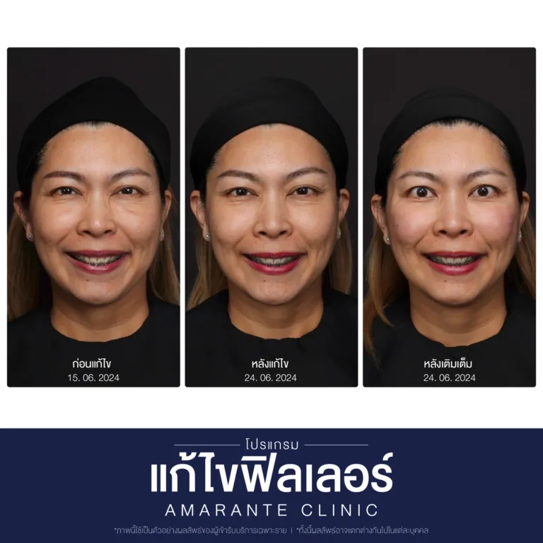 BA-แก้ไข-ฟิลเลอร์-12-scaled