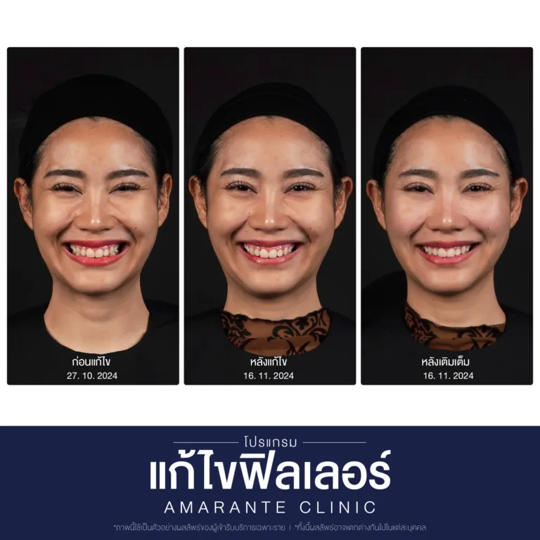 BA-แก้ไข-ฟิลเลอร์-16-scaled