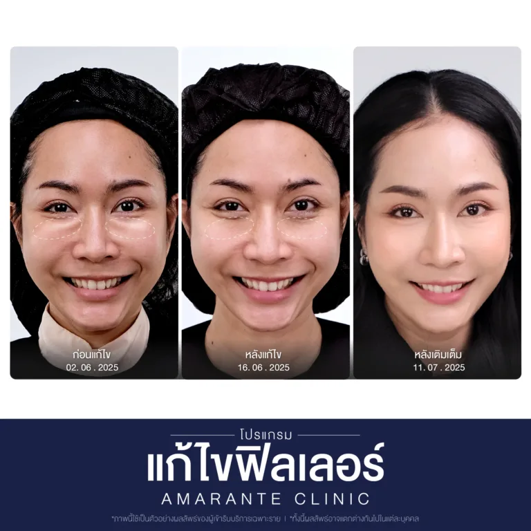 BA-แก้ไข-ฟิลเลอร์-17-scaled