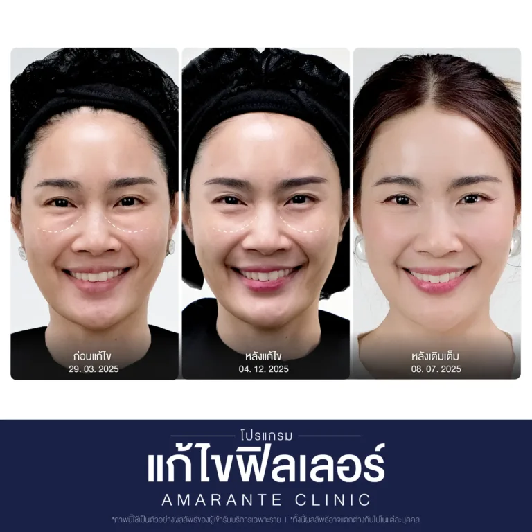 BA-แก้ไข-ฟิลเลอร์-19-scaled