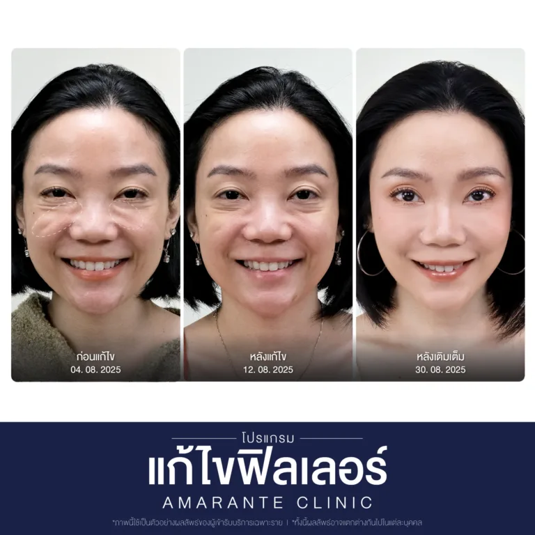 BA-แก้ไขฟิลเลอร์-คุณเดย่า-01-scaled