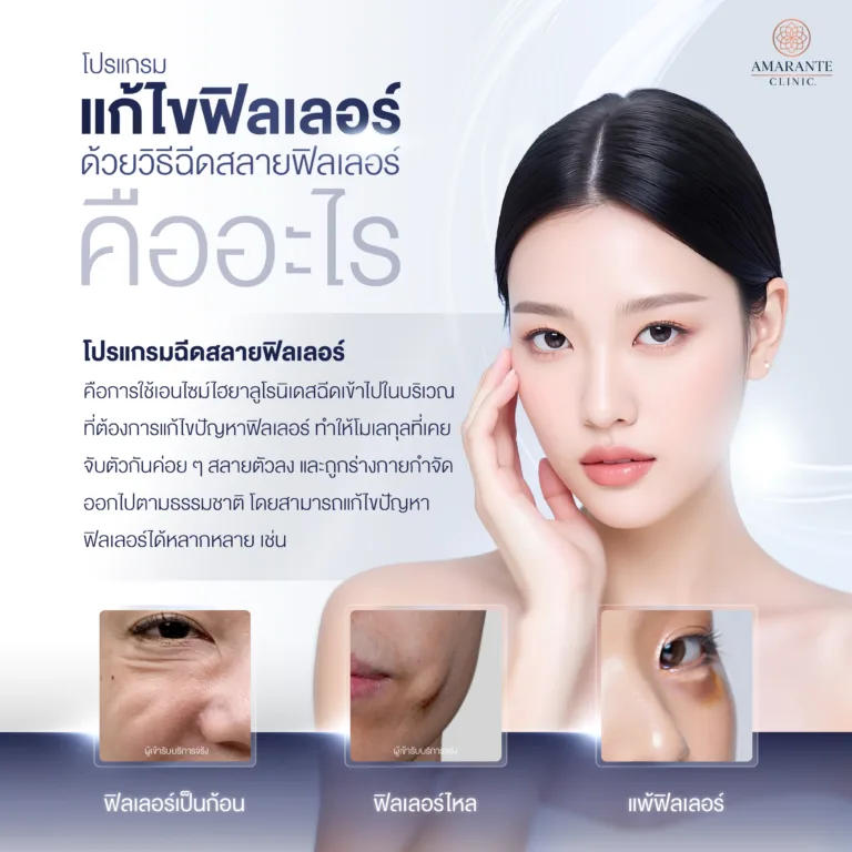 แก้ไขฟิลเลอร์ด้วยฉีดสลายฟิลเลอร์ คืออะไร?