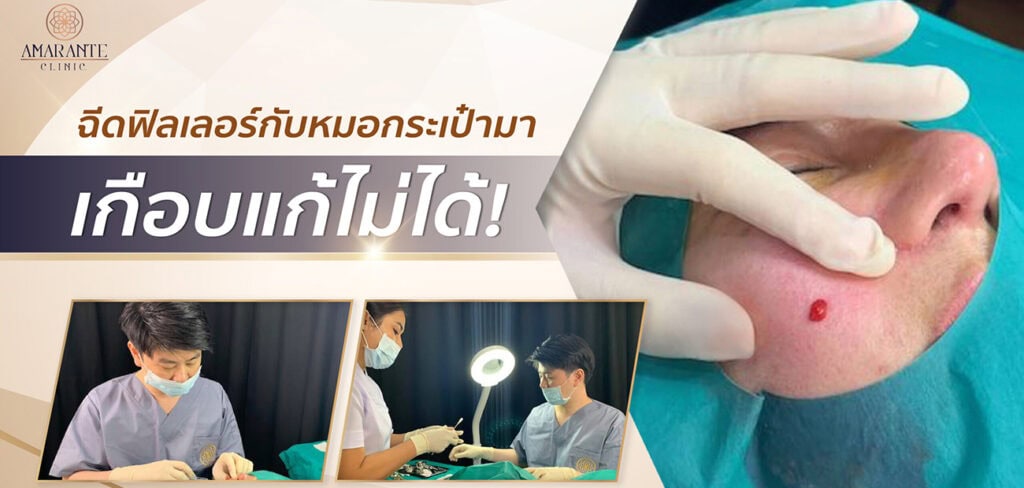 อุทาหรณ์ ฉีดฟิลเลอร์หมอกระเป๋า