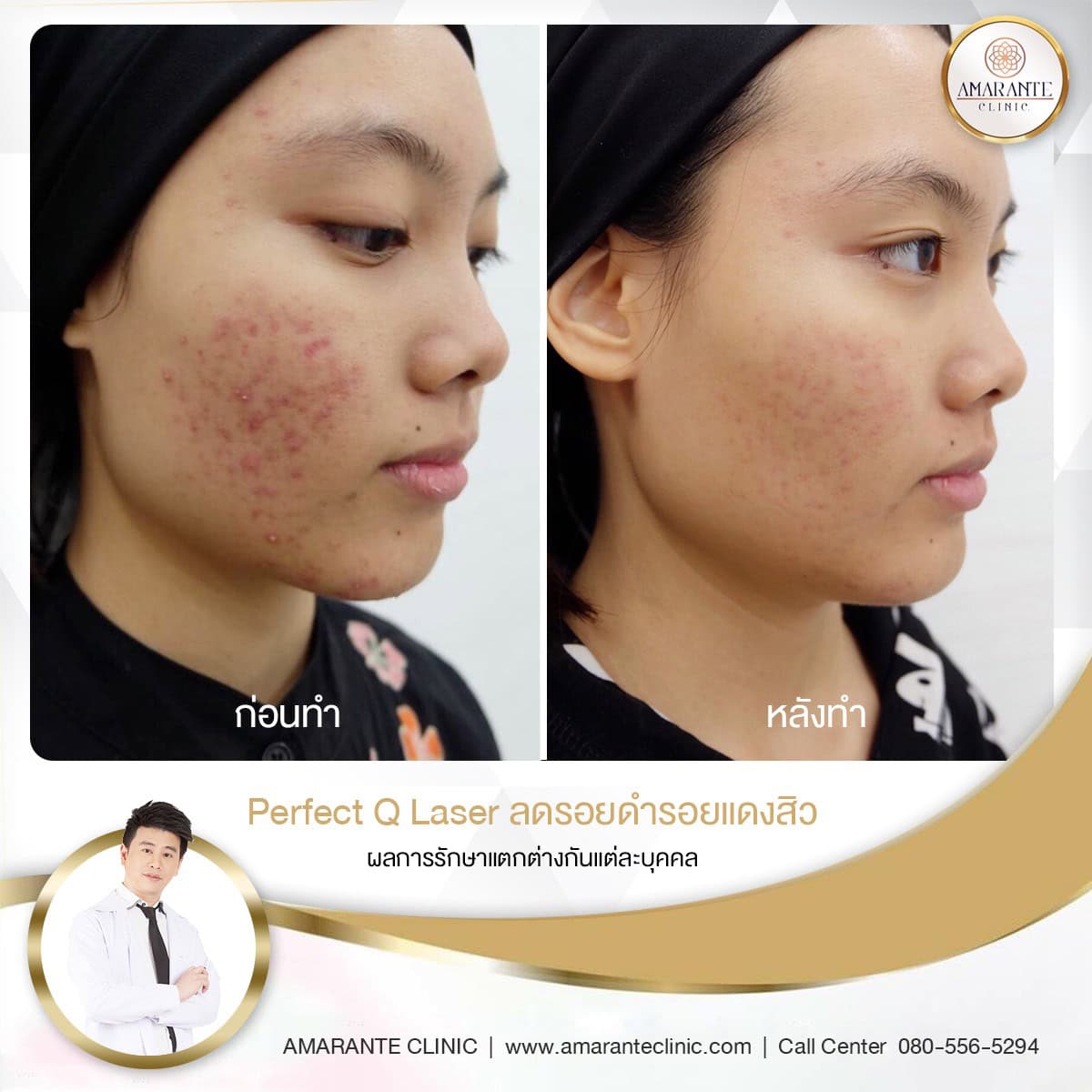 Perfect Q Laser เลเซอร์รอยสิว