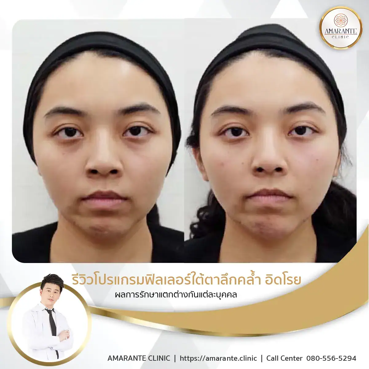 ฉีดฟิลเลอร์ใต้ตา-ฉีดฟิลเลอร์ปรับรูปหน้า-10
