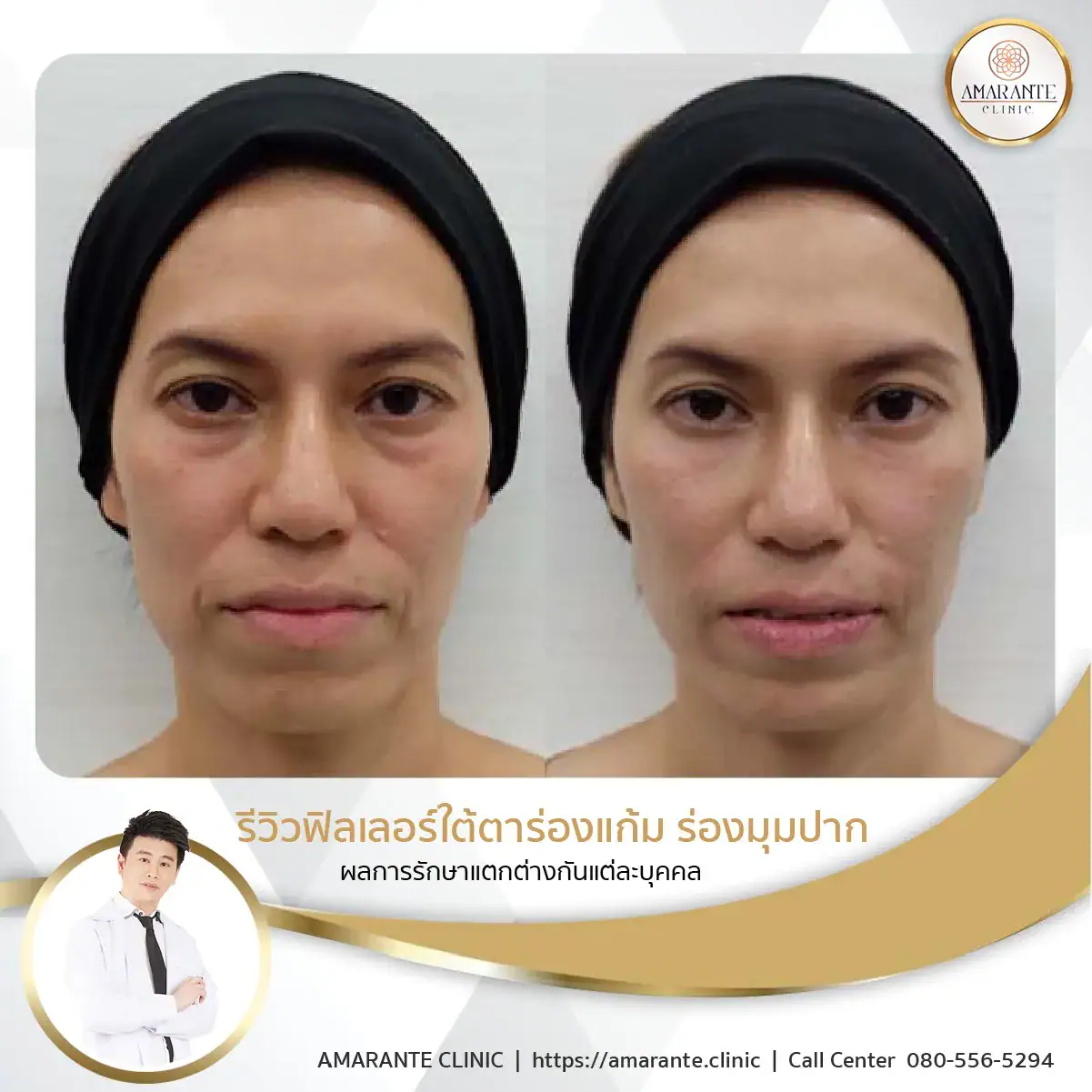 ฉีดฟิลเลอร์ใต้ตา-ฉีดฟิลเลอร์ปรับรูปหน้า-11