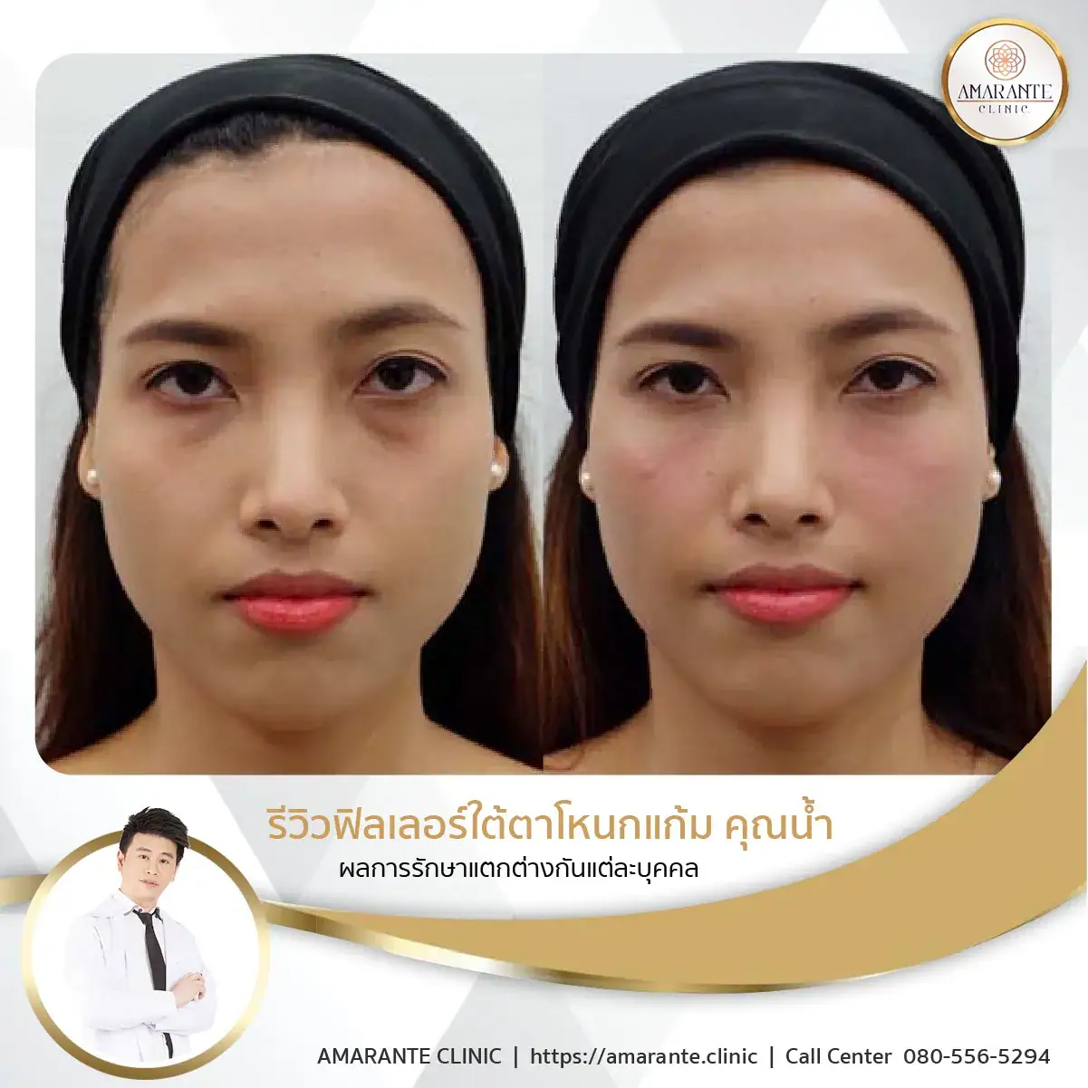 ฉีดฟิลเลอร์ใต้ตา-ฉีดฟิลเลอร์ปรับรูปหน้า-12