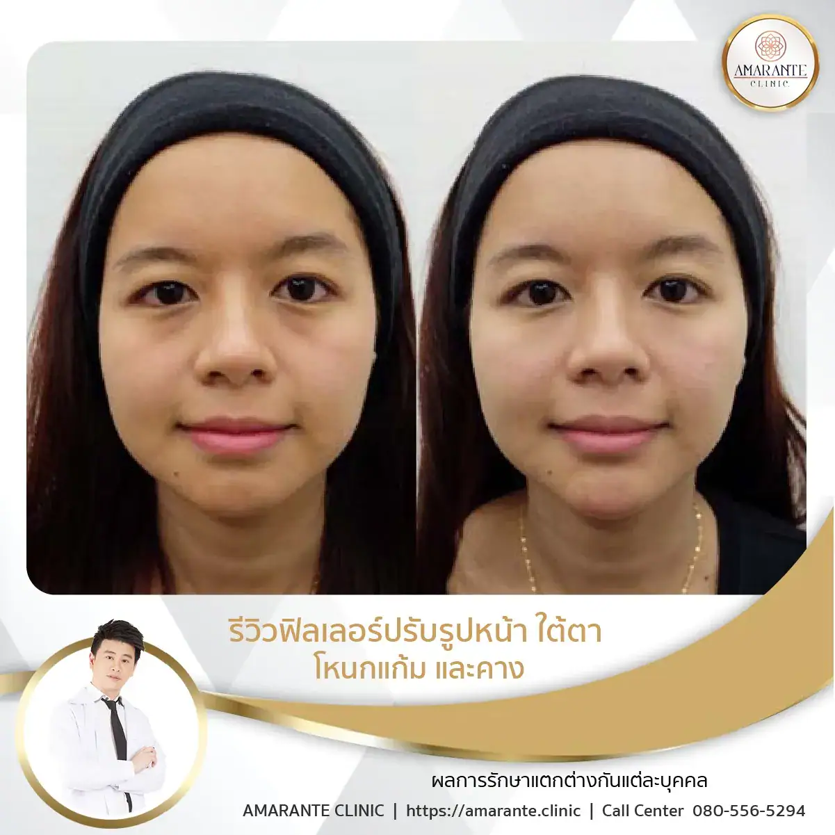 ฉีดฟิลเลอร์ใต้ตา-ฉีดฟิลเลอร์ปรับรูปหน้า-13