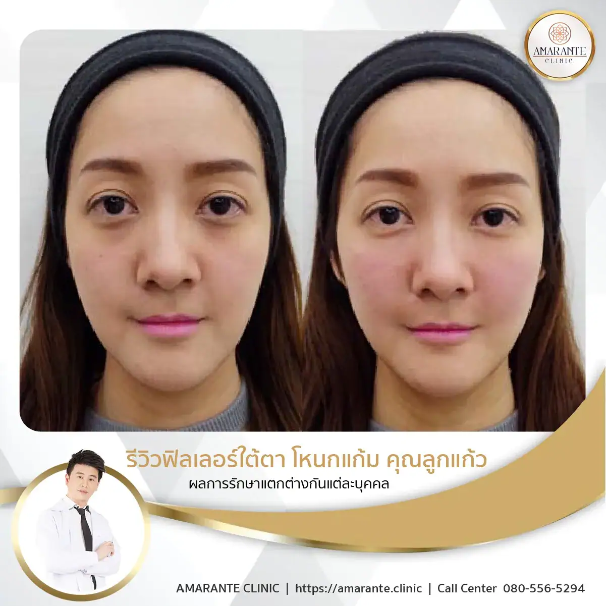 ฉีดฟิลเลอร์ใต้ตา-ฉีดฟิลเลอร์ปรับรูปหน้า-14