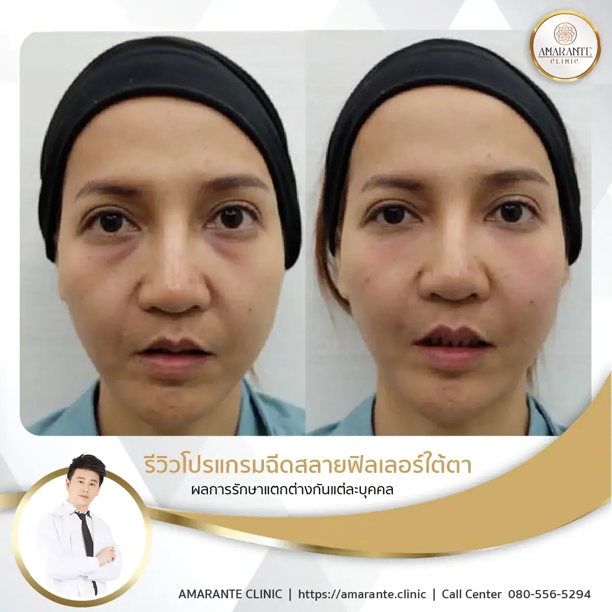 ฉีดฟิลเลอร์ใต้ตา-ฉีดฟิลเลอร์ปรับรูปหน้า-15