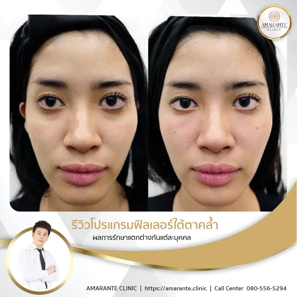 ฉีดฟิลเลอร์ใต้ตา-ฉีดฟิลเลอร์ปรับรูปหน้า-29