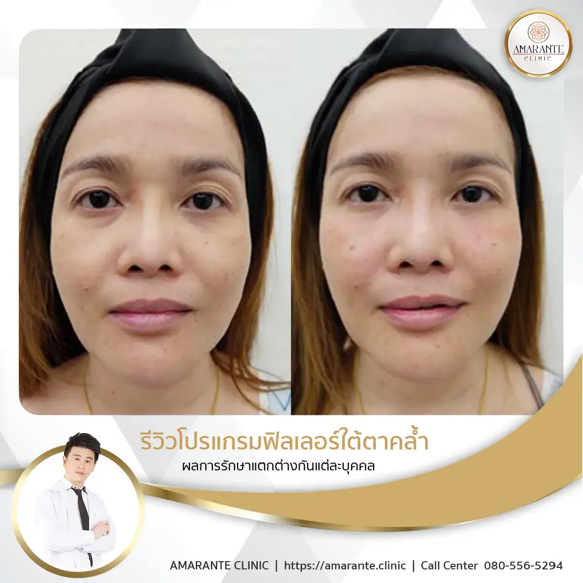ฉีดฟิลเลอร์ใต้ตา-ฉีดฟิลเลอร์ปรับรูปหน้า-54
