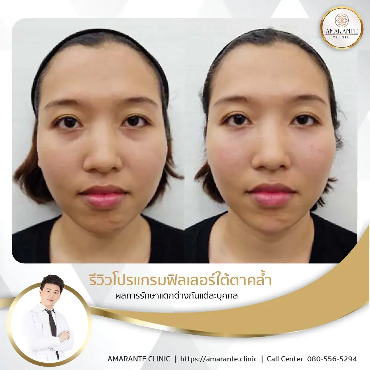 ฉีดฟิลเลอร์ใต้ตา-ฉีดฟิลเลอร์ปรับรูปหน้า-55