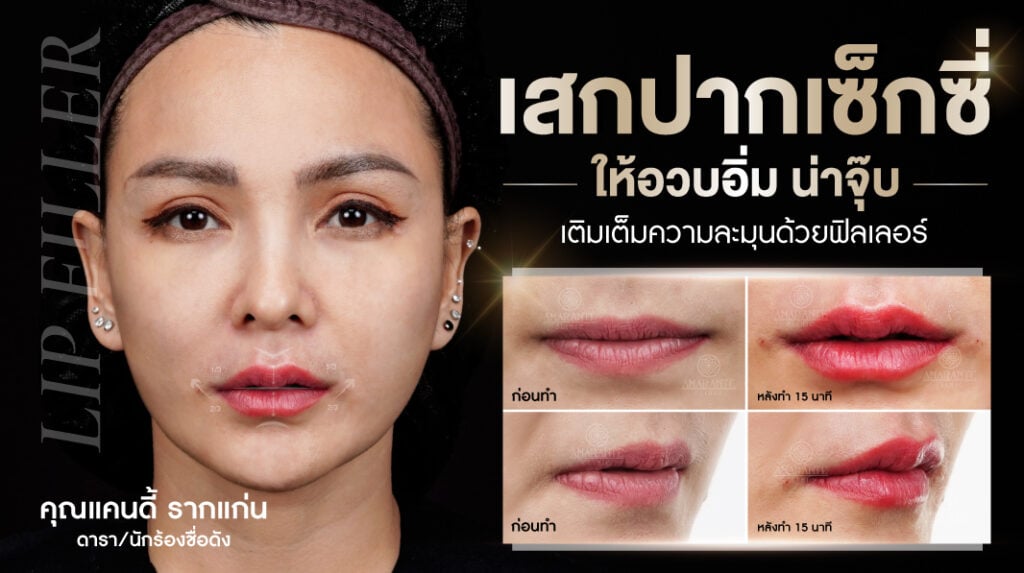 รีวิวฉีด ฟิลเลอร์ปาก , คุณแคนดี้