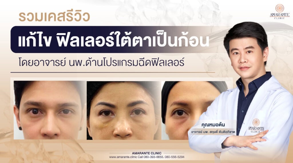 ฟิลเลอร์ใต้ตาเป็นก้อน