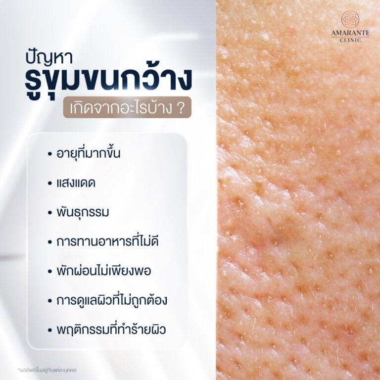 รูขุมขนกว้างเกิดจากอะไร