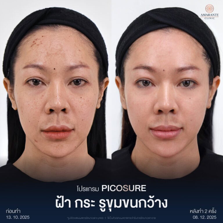 รีวิวกระชับรูขุมขน ด้วย Pico Laser ที่ Amarante Clinic
