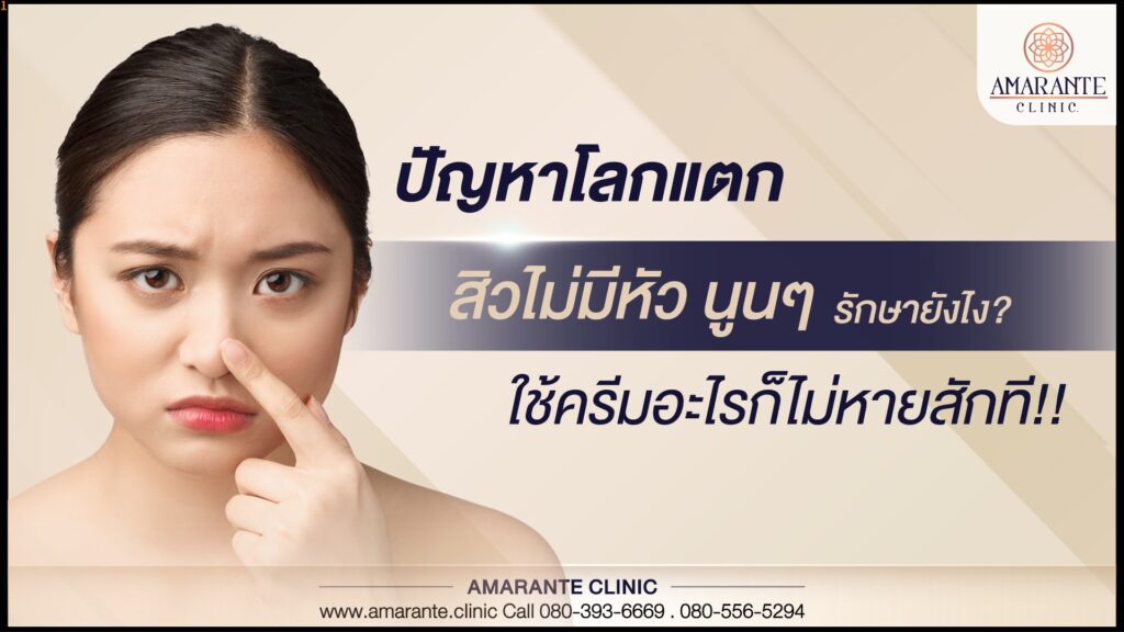 ปัญหาโลกแตก สิวไม่มีหัว นูนๆ รักษายังไง ใช้ครีมอะไรก็ไม่หายสักที!!