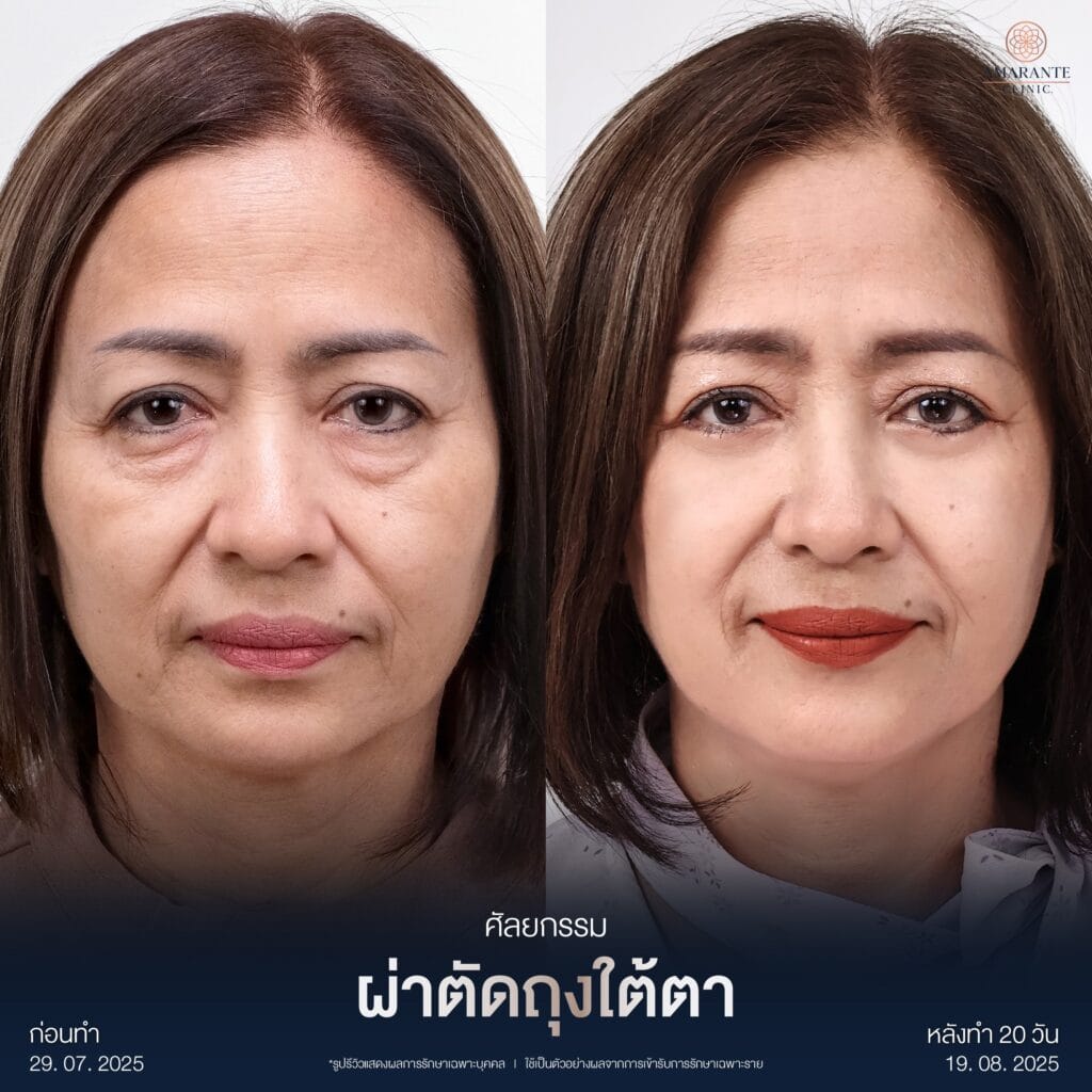 รีวิวผ่าตัดถุงใต้ตา